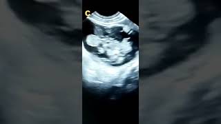 OVARIAN CYSTIC TERATOMA DERMOID CYST [upl. by Mackay797]