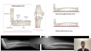 Monteggia and Galeazzi Fracture by Dr Umar Farooq [upl. by Labinnah]