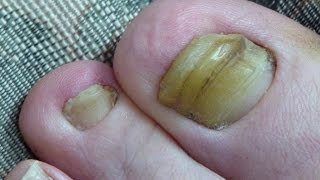 Toenail Fungus Cured 2 Years Progress [upl. by Aland]