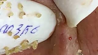 Loan Nguyen Acne Treatment 1630mh [upl. by Nhojleahcim]