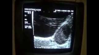 TUBOOVARIAN CYSTIC MASS with P I D [upl. by Sharma]