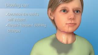 Sialorrhea Excessive Drooling  Decreasing Saliva Production [upl. by Ames]