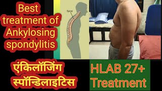 Treatment of Ankylosing spondylitisएंकोलॉजिंग स्पॉन्डिलाइटिस Drjha Acupuncture Mira road [upl. by Oswald]