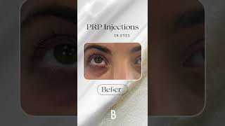 Before amp After Results of PRP Injections for Brighter Firmer Eyes [upl. by Aennaej]