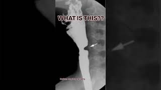 🎯👉 FIRST OF THREE ANATOMICAL CONSTRICTIONS OF THE ESOPHAGUS 👉IN BARIUM ESOPHAGOGRAPHY🌺 [upl. by Ziul]