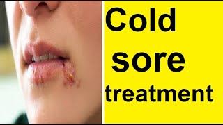 Cold sore treatment [upl. by Tama]