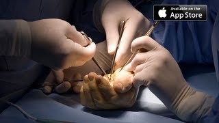 Carpal Tunnel Surgery [upl. by Thurlow]