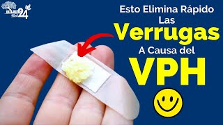 Como Eliminar Verrugas Combate las VERRUGAS con Ajo y Limón  Remedios Caseros Facil 24 [upl. by Wharton]