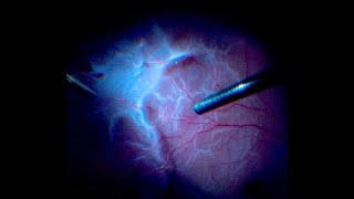 Vitrectomy for PVRInduced Retinal Detachment with Peripheral Retinotomy Ensuring Retinal Stability [upl. by Warila]