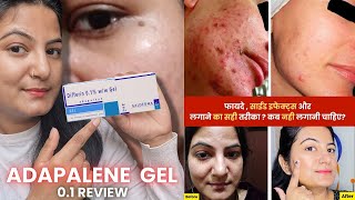 How to Use Adapalene Gel 01  Full Detail Video  Best Gel For Removing Blackheads and Pimples [upl. by Eentirb201]