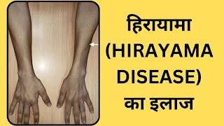 Hirayama Disease [upl. by Lorsung389]