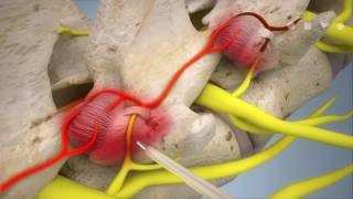 Endoscopic rhizotomy [upl. by Netsruk]