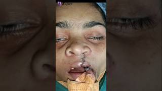 Secondary Lip Revision amp Alveolar Bone Grafting Surgery in Adult Cleft Patient [upl. by Imehon]