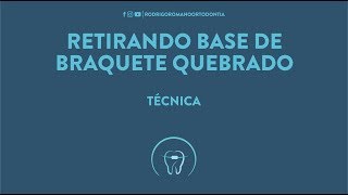 Retirando a base de braquete quebrado  Técnica Ortodôntica [upl. by Nivrehs]