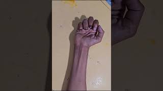 Ulnar nerve injury Claw hand [upl. by Atwater]