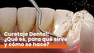 Curetaje Dental ¿Qué es y cómo se hace [upl. by Quartet]