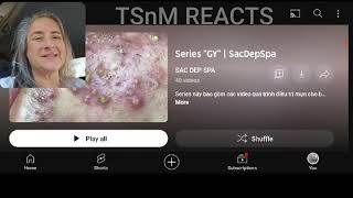 TSnM Reacts Pimple Pops Sac Dep Spa GY [upl. by Nedgo]