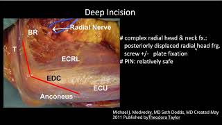 Elbow Approach For Radial Head Neck fracture [upl. by Farrand248]