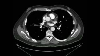 Tromboembolismo Pulmonar Angio tomografia [upl. by Taylor749]