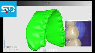 MEDIT i500でデンチャーをスキャン！ [upl. by Bowen733]