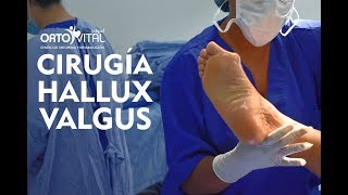 CIRUGÍA HALLUX VALGUS [upl. by Sweeney26]