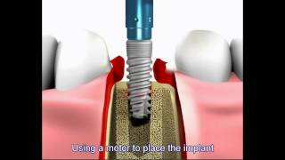 Dental implant procedure [upl. by Ellinnet]