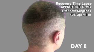 Hair Transplant Review 2013 19 DAY RECOVERY TIME LAPSE OF DONOR AREA POST OP [upl. by Nivat967]