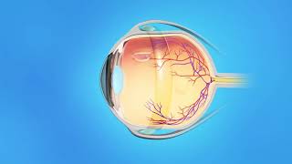 US Ophthalmic Detached Retina Vitrectomy [upl. by Shamrao]