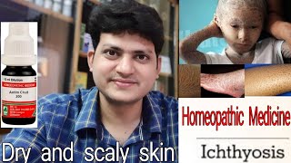 Ichthyosis  रूखी सूखी फटी हुई त्वचा  Homeopathic medicine for Ichthyosis  explain [upl. by Yrian]