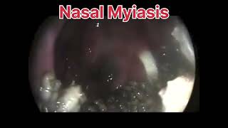 Nasal Myiasis peenash  mbbs shorts [upl. by Lletnuahs]