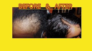 ALOPECIAHAIR LOSS HAIRSTYLE BRAID PATTERN  NO GLUE FOR WOMEN WITH FRAGILE EDGES amp SHORT HAIR [upl. by Zina234]