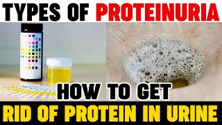 Types Of Proteinuria  How To Get Rid Of Protein In Urine  Kidney Expert  Karma Ayurveda Reviews [upl. by Aniweta562]