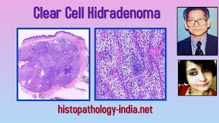 Pathology of Clear Cell Hidradenoma  Dr Sampurna Roy MD dermpath dermatopathology [upl. by Ssidnac108]