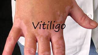 How to Pronounce Vitiligo [upl. by Stoddart]