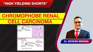 High Yielding Shorts82 HYS82Chromophobe renal cell carcinoma by Dr Devesh Mishra [upl. by Asiram]