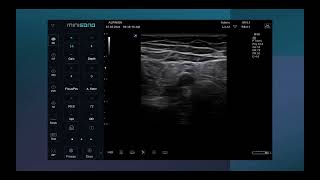 Ultrasound Guided Adductor canal block [upl. by Edmondo]