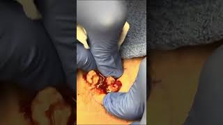 Back Cyst Pop  Dr Derm [upl. by Noyad77]