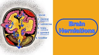 Brain Herniations and Raised ICP [upl. by Trilbie]