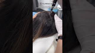 Calecim Advanced Hair System MicroNeedling at Dr MediSpa [upl. by Nap]