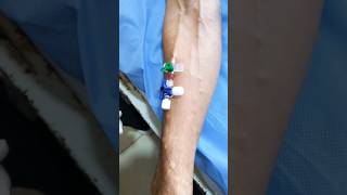 IV Cannulation subscribe cannula cannulation health hospital shortsindia [upl. by Yrallih]