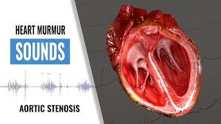 Aortic Stenosis Heart Sound  Heart Murmur  Christina NP [upl. by Nnorahs]