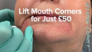 Lift Drooping Mouth Corners in 5 Minutes for Only £50 tunbridgewells [upl. by Doreg37]