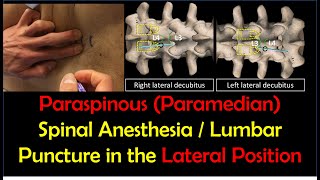 quotHowToquot Guide  Paraspinous Lumbar Puncture  Spinal Anesthesia Lateral Position [upl. by Aerdnat521]