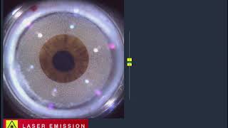 Baştan sona FemtoLasik Femto Lasik with Alcon LensX and Wavelight EX500 Excimer Laser [upl. by Yank]