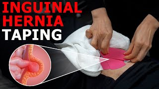 Easy Support for Inguinal Hernia A Physical Therapist’s Expert Guide [upl. by Duarte84]