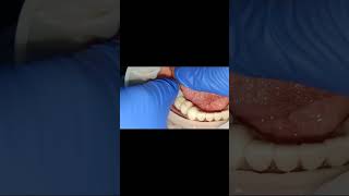 2 times failed lower molar implant site replaced with screw retaiend short implants bridge fixing [upl. by Carmella505]