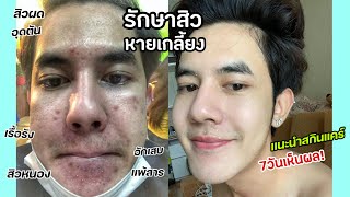 แชร์ประสบการณ์หน้าสิว10ปี สิวเห่อจนหน้าพัง ทำไงให้กลับมาเนียนกริบ หน้าใสเกิน l Fararim Story [upl. by Stevy]