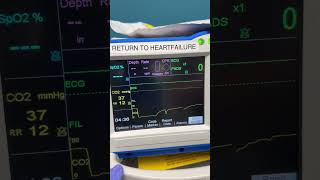 ETCO2 tracing waveform on the Zoll R series [upl. by Laurence]