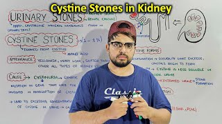 Cystine Stones A Type of Kidney stones Cistinuria [upl. by Kay]