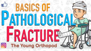 Pathological FRACTURE Causes Treatment Mirels Score NEET PG USMLE The Young Orthopod [upl. by Alohs436]